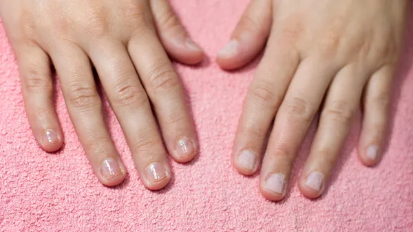 Reconstrucción de Uñas Mordidas
