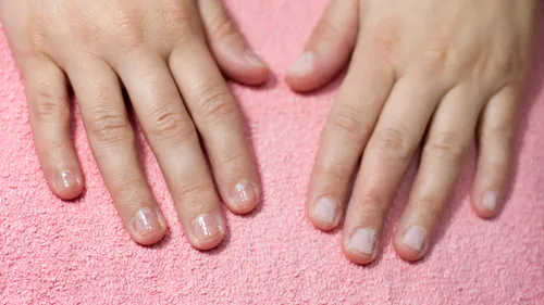 Reconstrucción de Uñas Mordidas