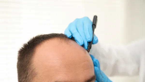 Tricopigmentación